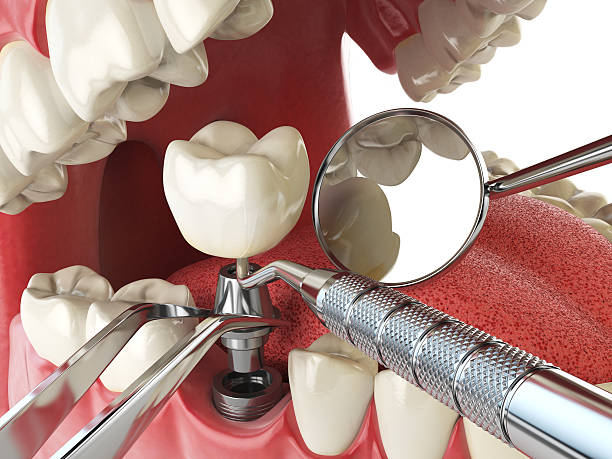 Best Emergency Dentist for Knocked-Out Tooth in Hudson, NY
